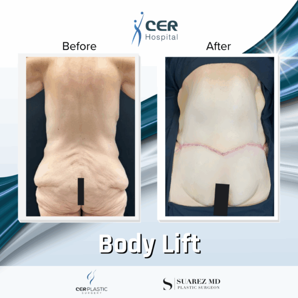Body Lift - 075 - Image 10