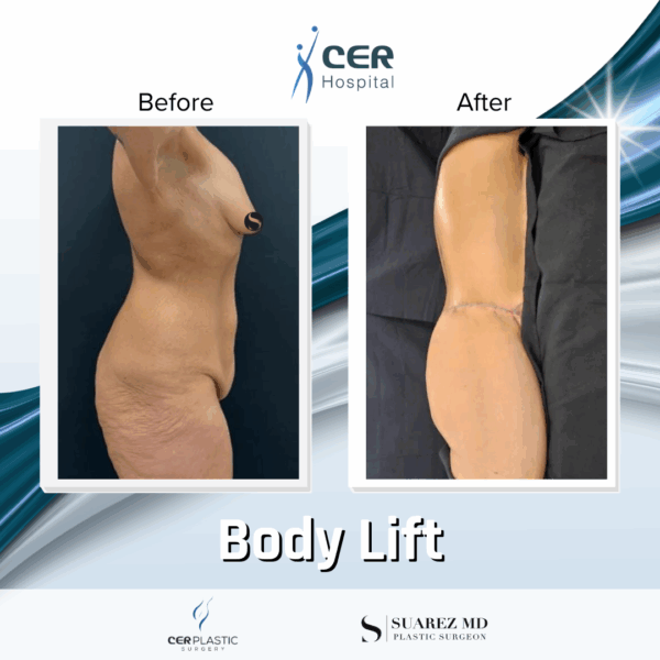 Body Lift - 304 - Image 9
