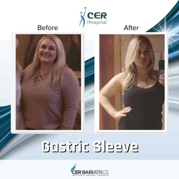 Gastric Sleeve