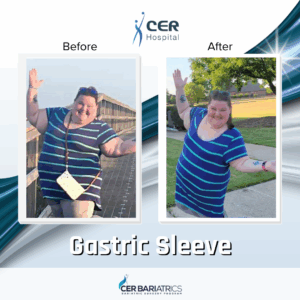 Gastric Sleeve