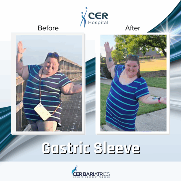 Gastric Sleeve