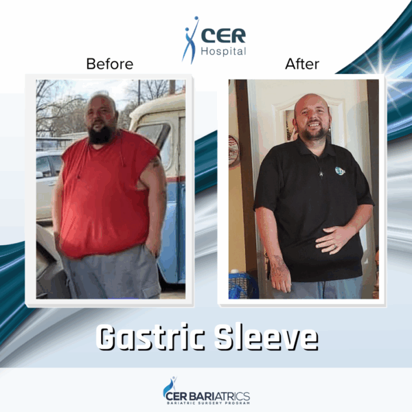 Gastric Sleeve