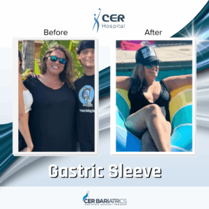 Gastric Sleeve