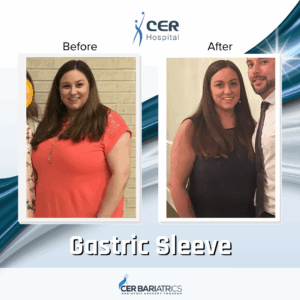 Gastric Sleeve