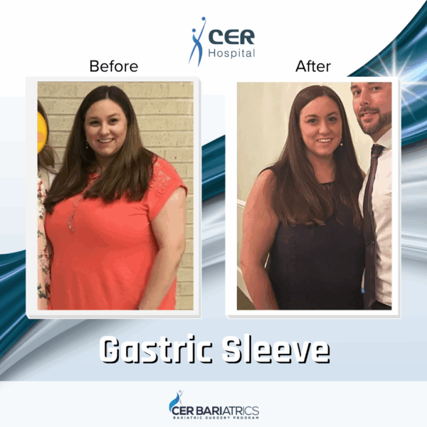 Gastric Sleeve