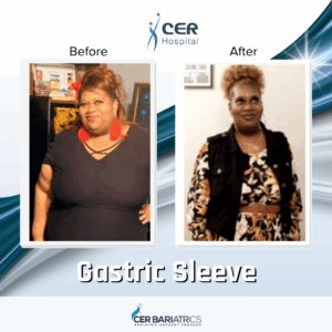 Gastric Sleeve
