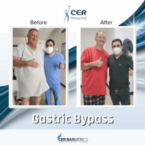 Gastric Bypass
