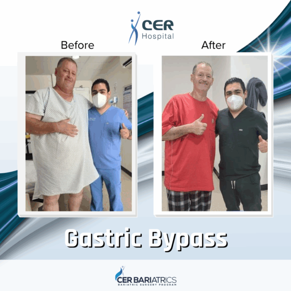 Gastric Bypass