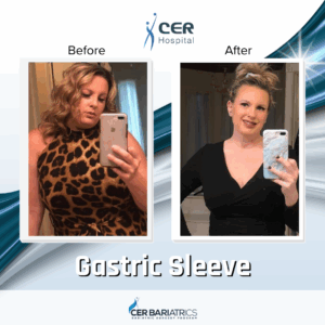 Gastric Sleeve