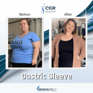Gastric Sleeve