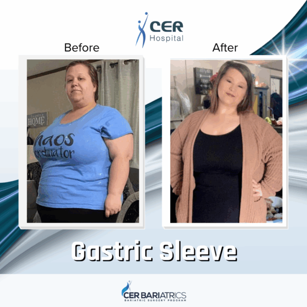 Gastric Sleeve