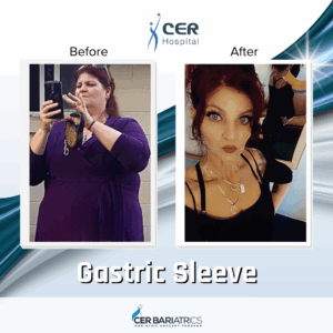 Gastric Sleeve