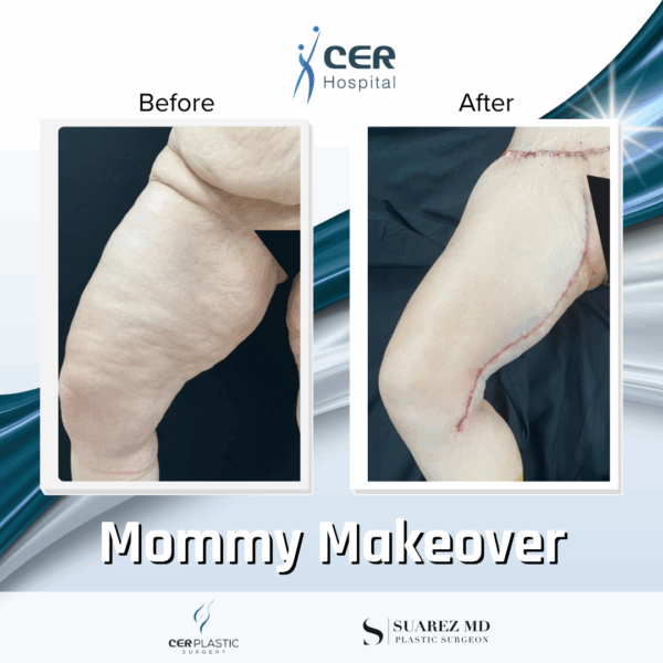 Mommy Makeover - 311 - Image 12