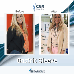 Gastric Sleeve