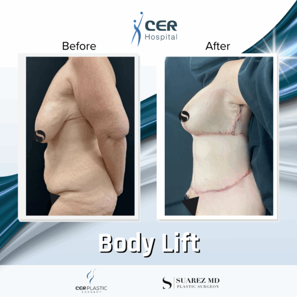 Body Lift -2094 - Image 11