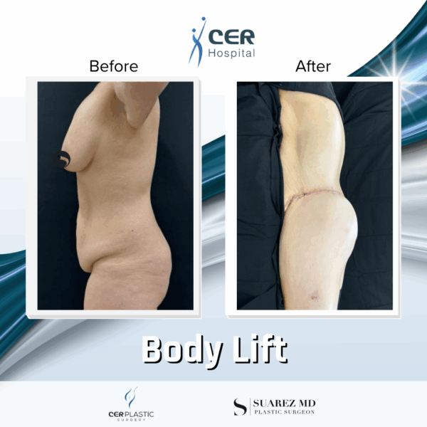 Body Lift - 26064 - Image 10