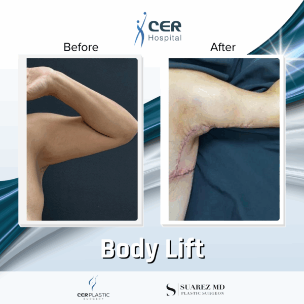 Body Lift -14064 - Image 10