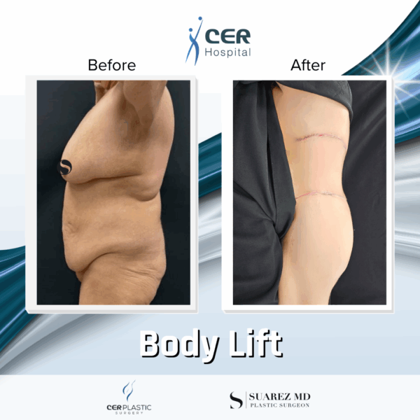 Body Lift - 20054 - Image 11