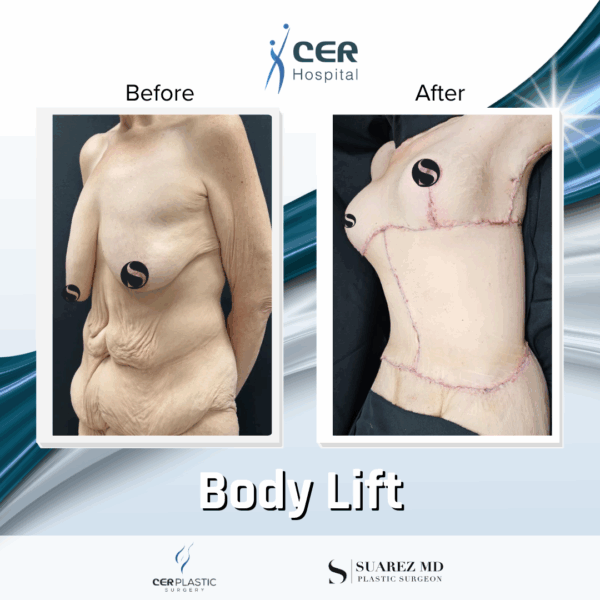 Body Lift - 17054 - Image 10