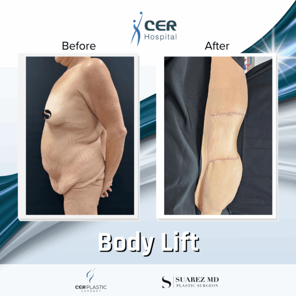 Body Lift - 8054 - Image 11