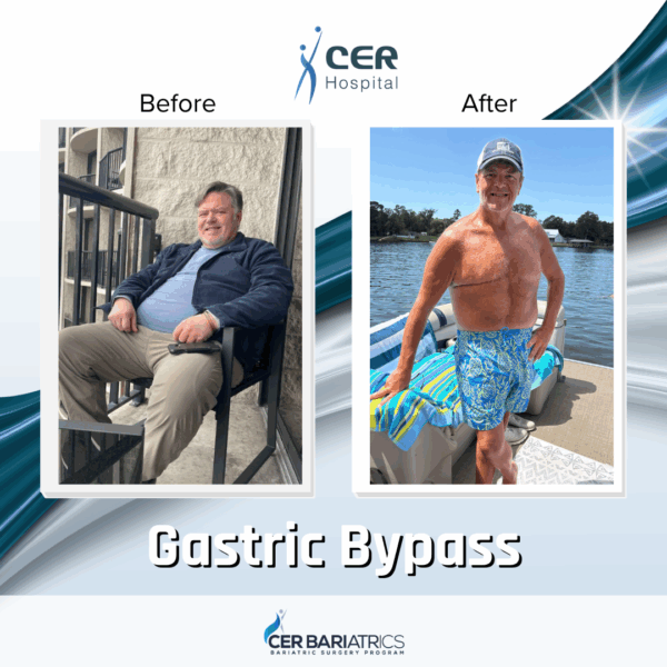 Gastric Bypass - Image 7