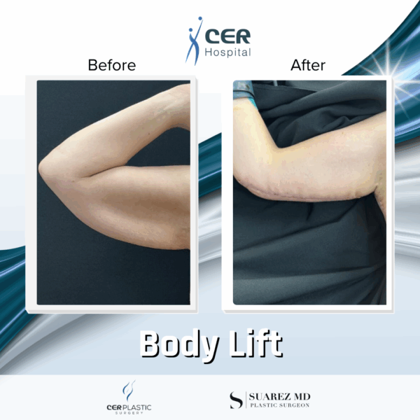 Body Lift - 165 - Image 11