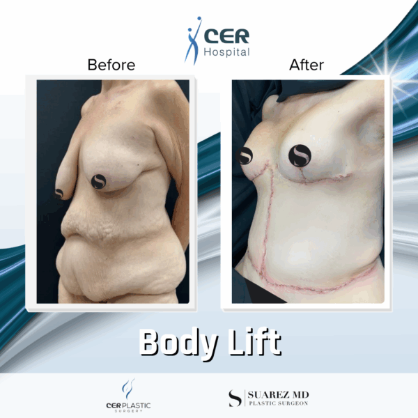 Body Lift - 075 - Image 11