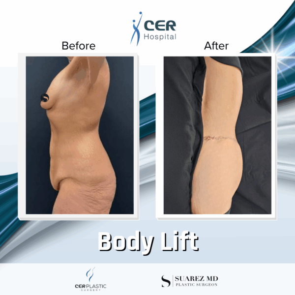 Body Lift - 304 - Image 10