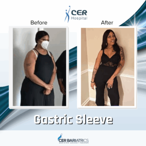 Gastric Sleeve