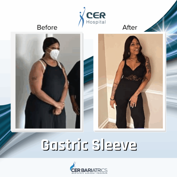 Gastric Sleeve