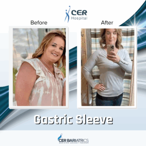 Gastric Sleeve