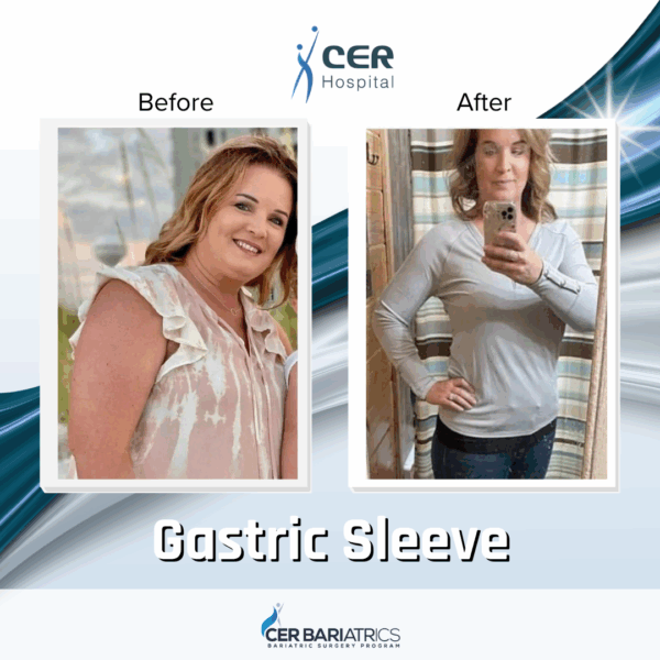 Gastric Sleeve