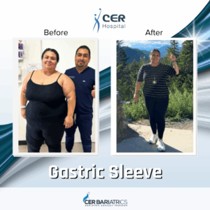 Gastric Sleeve