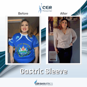 Gastric Sleeve
