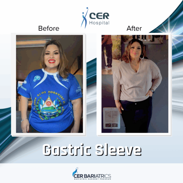 Gastric Sleeve - Image 2