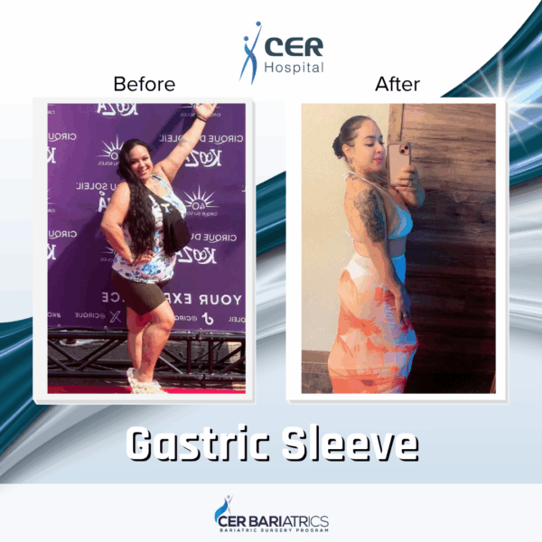 Gastric Sleeve