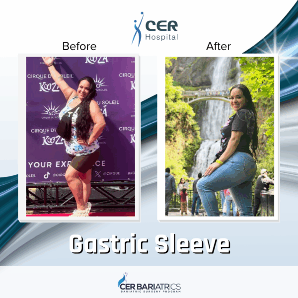 Gastric Sleeve - Image 2