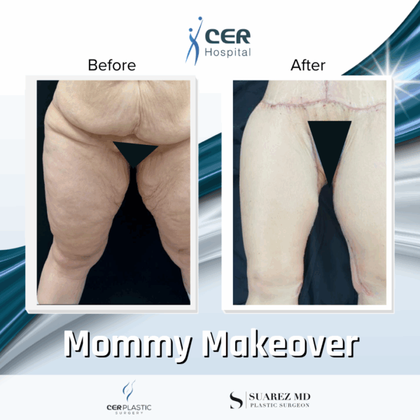 Mommy Makeover - 311 - Image 13