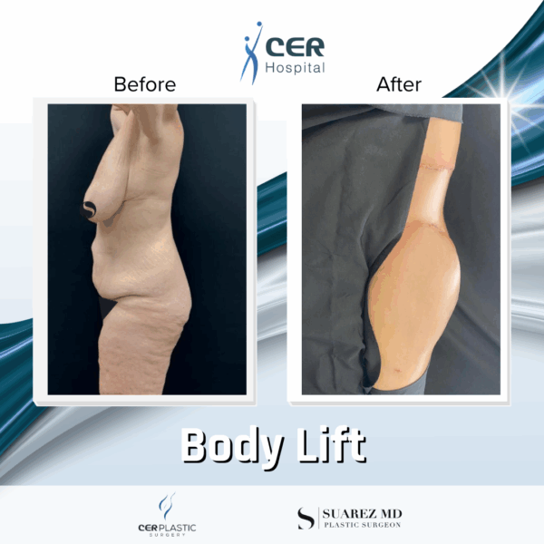 Body Lift -2094 - Image 12