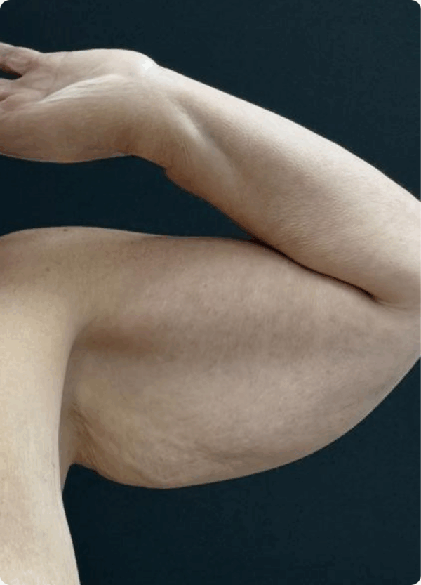 Body Lift -2094 - Image 3