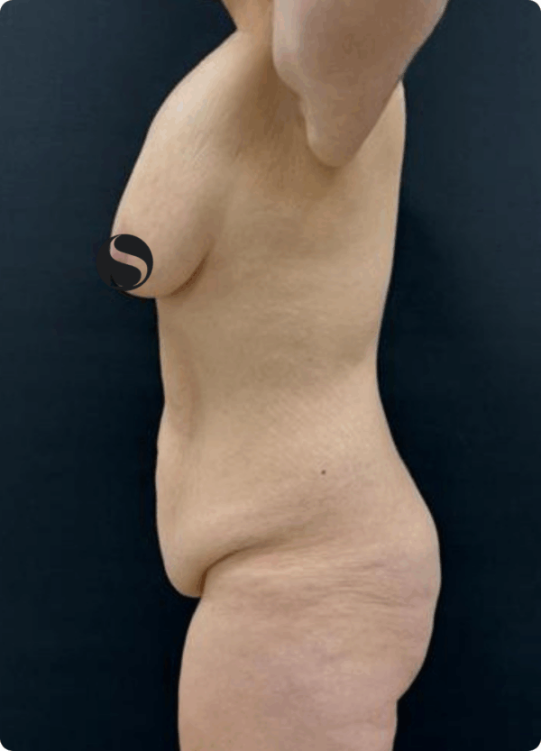 Body Lift - 26064 - Image 3