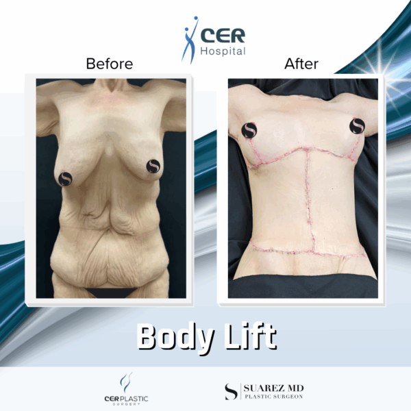Body Lift - 17054 - Image 11