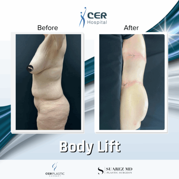 Body Lift - 165 - Image 10