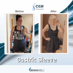 Gastric Sleeve
