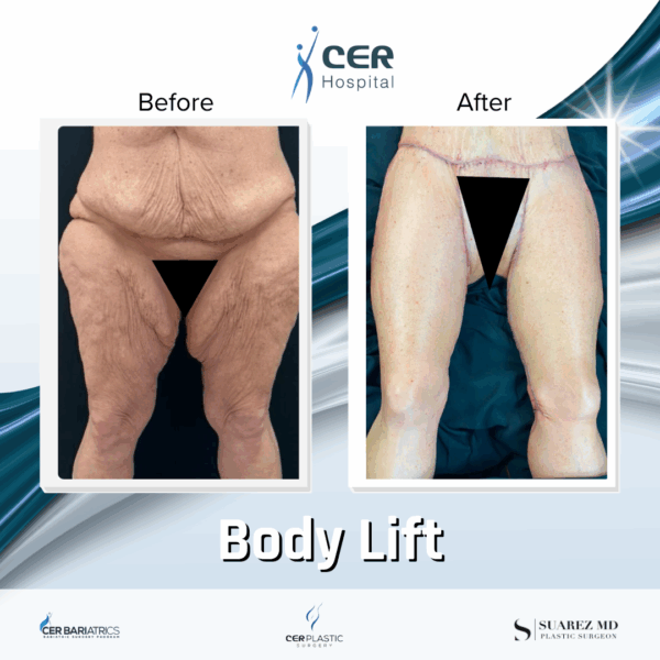 Body Lift - 291 - Image 11