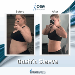 Gastric Sleeve