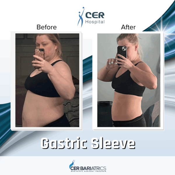 Gastric Sleeve