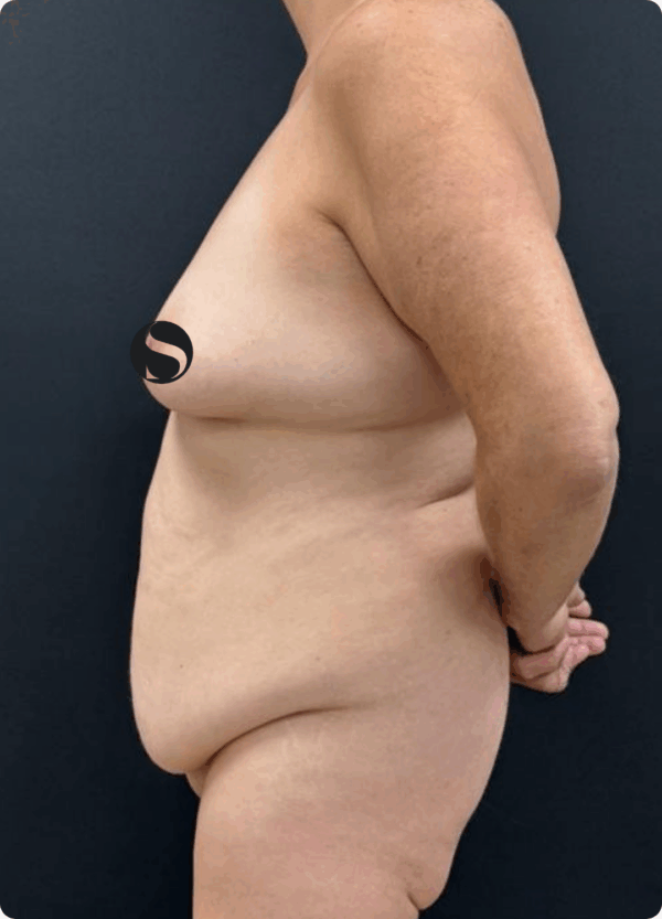 Body Lift - 037 - Image 3
