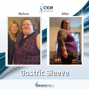 Gastric Sleeve