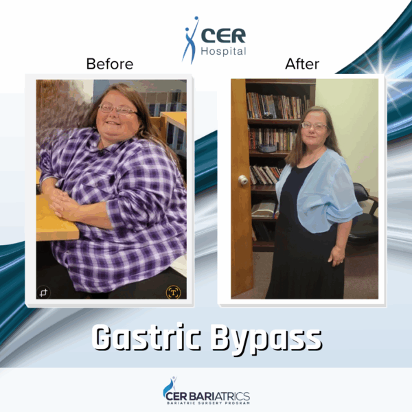 Gastric Bypass